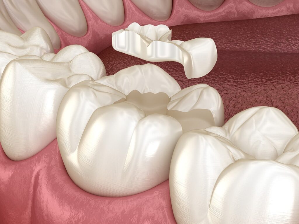 Illustration of a dental procedure showing a tooth-colored inlay being placed onto a molar. Surrounding teeth and gums are visible, emphasizing oral health care.