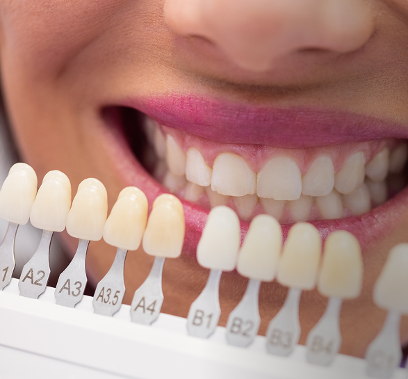 Dental Veneers