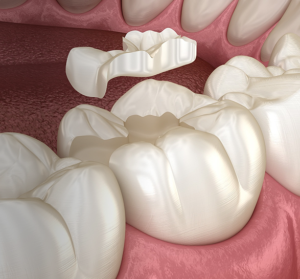Illustration of a dental procedure showing a tooth-colored inlay being placed onto a molar. Surrounding teeth and gums are visible, emphasizing oral health care.