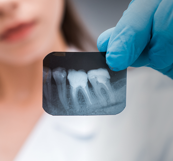 Tooth X Ray