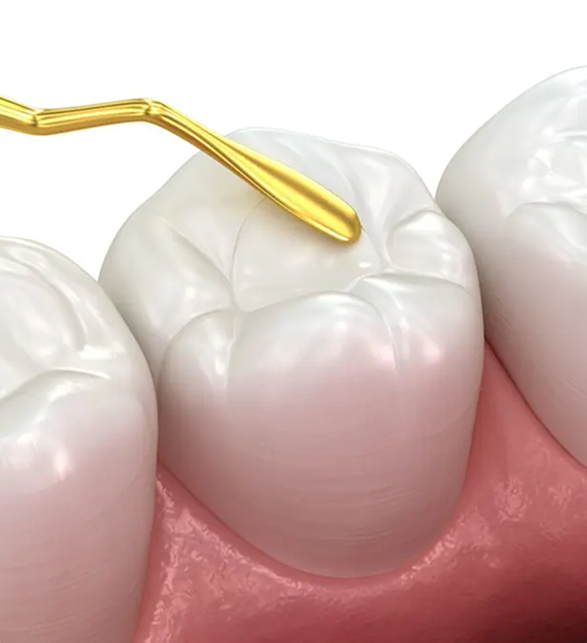 Benefits of Dental Sealants