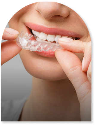 Apply Day White® Clear Aligner Tray & Wait