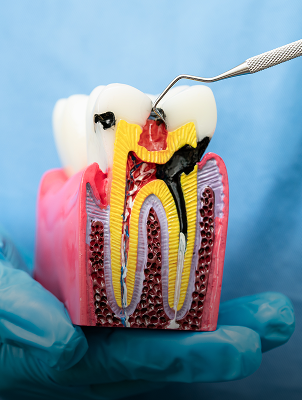 Remove the Decay - Inlay Procedure